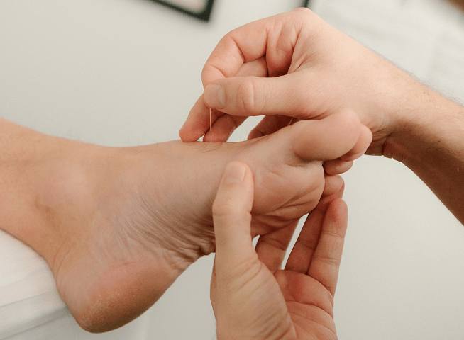 Behandling med akupunktur